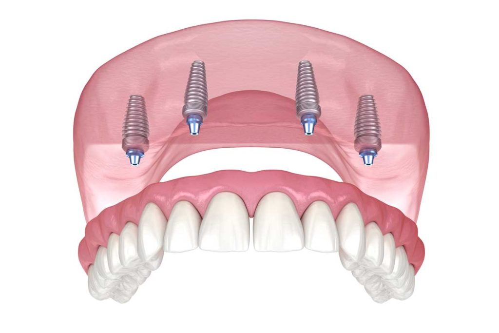 All-on-4 dental implants